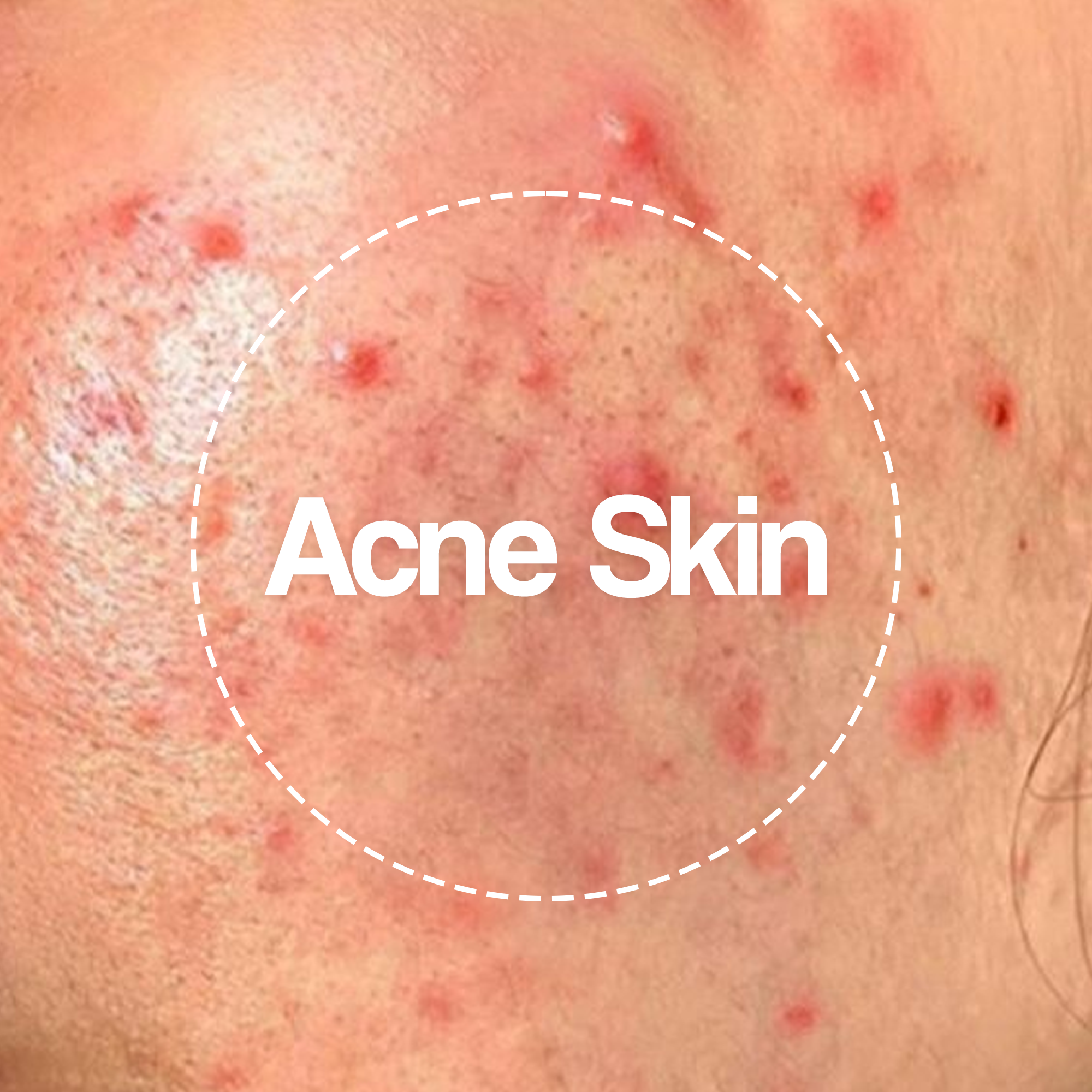 Skin Care Routine for Oily Skin: A Complete Guide for Acne-Prone Skin