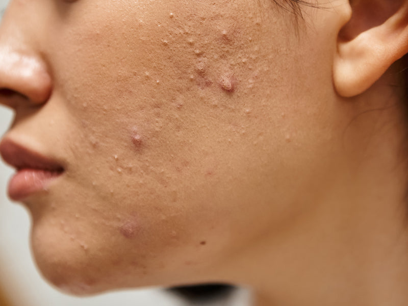 Acne: Causes, Types and Cure – Your Go-To Guide by Humuss Beauty