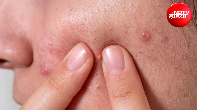Are pimples on your face increasing during the rainy season? Experts recommend doing these 3 things before bed, and you'll see results quickly.